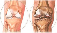 膝骨性关节炎的疼痛分类