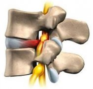 腰椎间盘突出是由哪些因素引起的