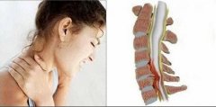 腰椎间盘突出症有哪些症状？