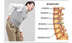 哪些原因可引起腰椎间盘突出症?