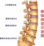 什么原因会导致腰椎间盘突出症的发生？