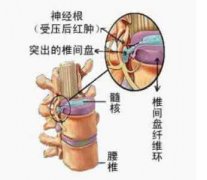 腰椎间盘突出症的症状表现有哪些？