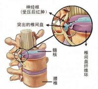 腰椎间盘突出患者会出现哪些不适?