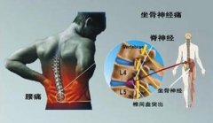 腰椎间盘突出症的自我疗法有哪些？