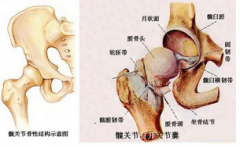 股骨头坏死的预防方法有哪些？